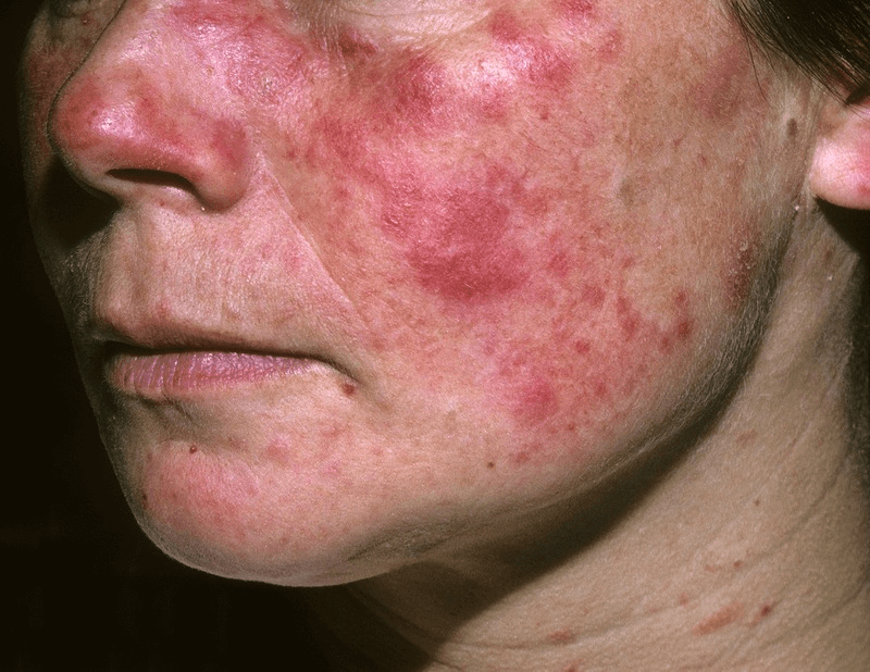 Lupus ban đỏ: Nguyên nhân, Triệu chứng và Cách chữa trị