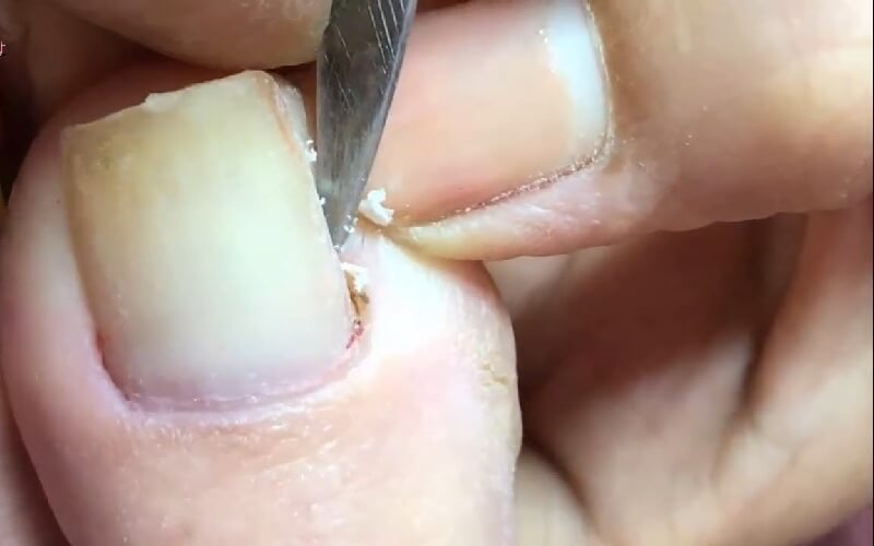 vệ sinh móng thường xuyên để tránh tình trạng móng chân bị mọc ngược