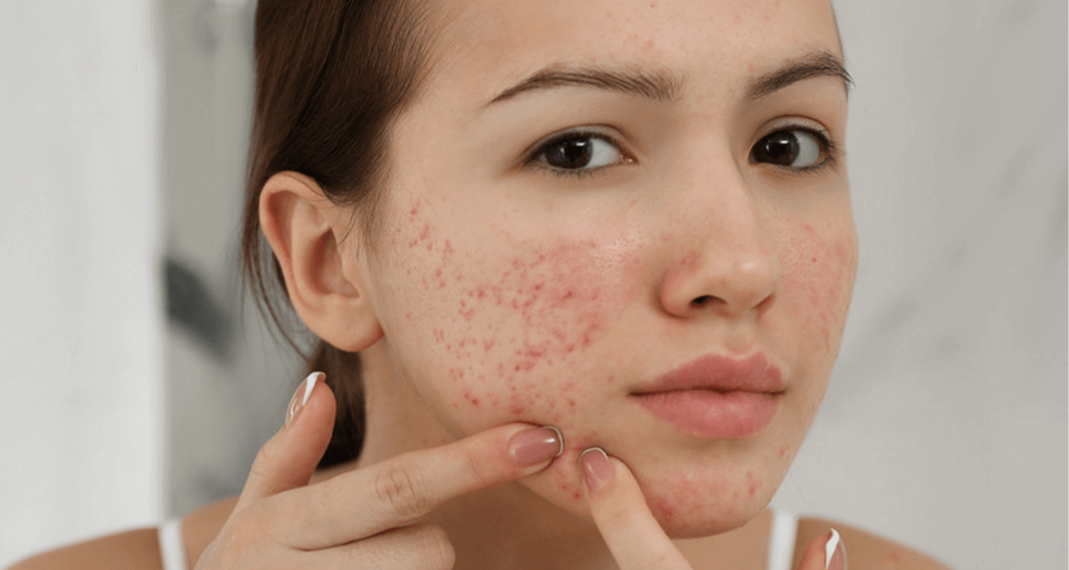 Phân biệt các loại mụn, nguyên nhân và cách chữa trị an toàn và hiệu quả