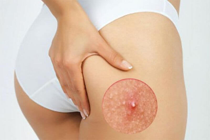 Tổng quan mụn mông: Nguyên nhân, Triệu chứng & Phương pháp chữa trị