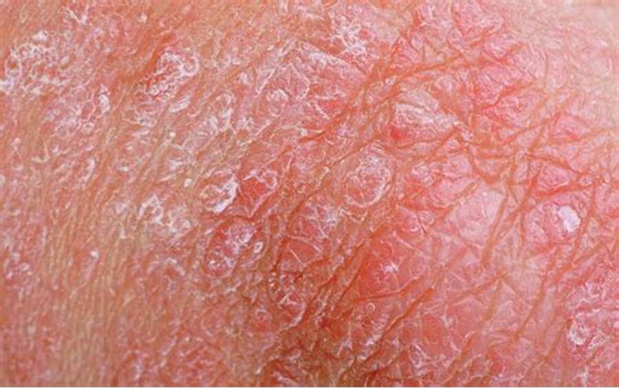 chữa trị ngứa dương vật