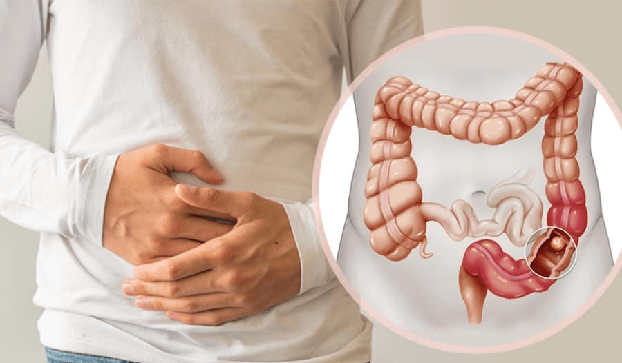 Polyp trực tràng là gì? Nguyên nhân, Triệu chứng và Phương pháp điều trị