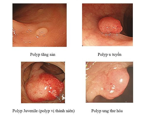 polyp trực tràng
