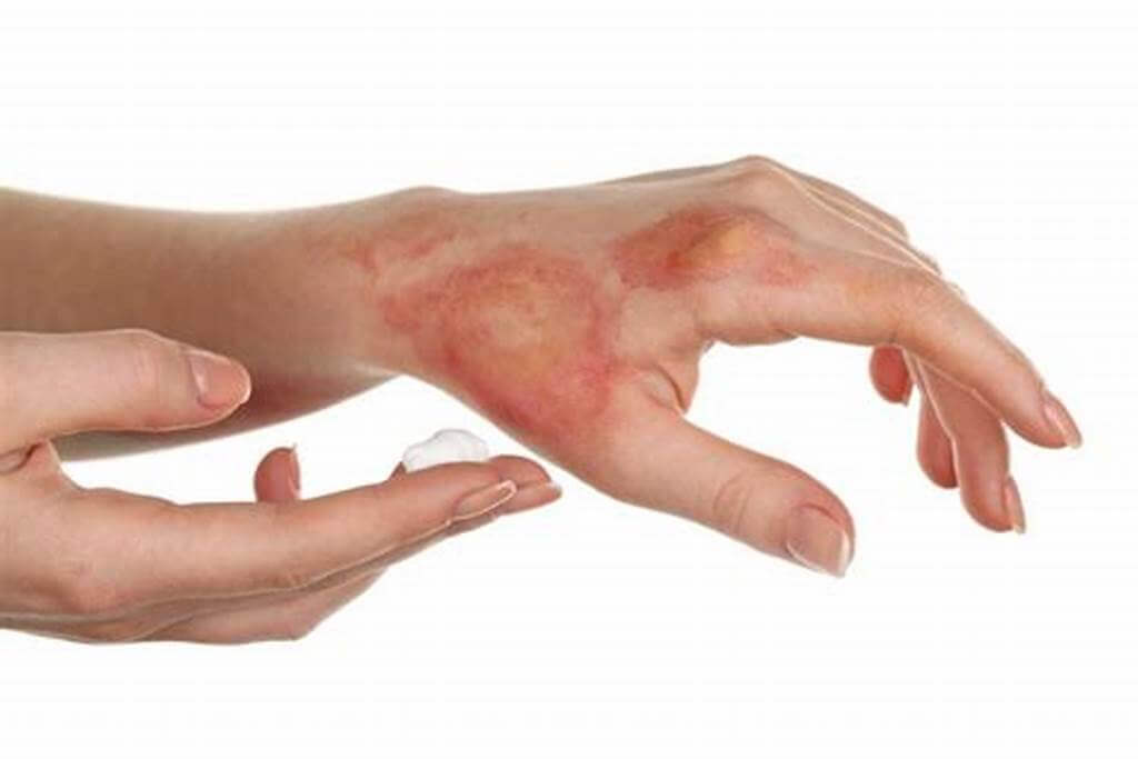 Vết thương hoại tử nguy hiểm như thế nào? Nguyên nhân, triệu chứng và cách chữa trị