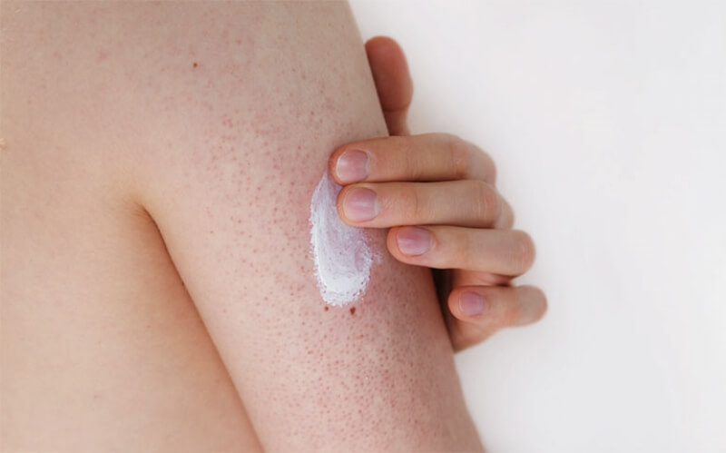 Dày sừng nang lông: Nguyên nhân, Dấu hiệu và Cách chữa trị hiệu quả