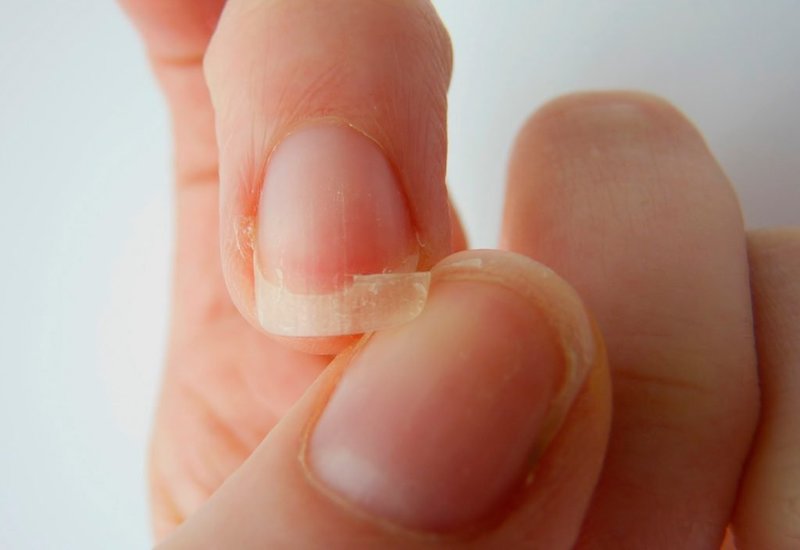 Lật móng: Nguyên nhân & Cách điều trị