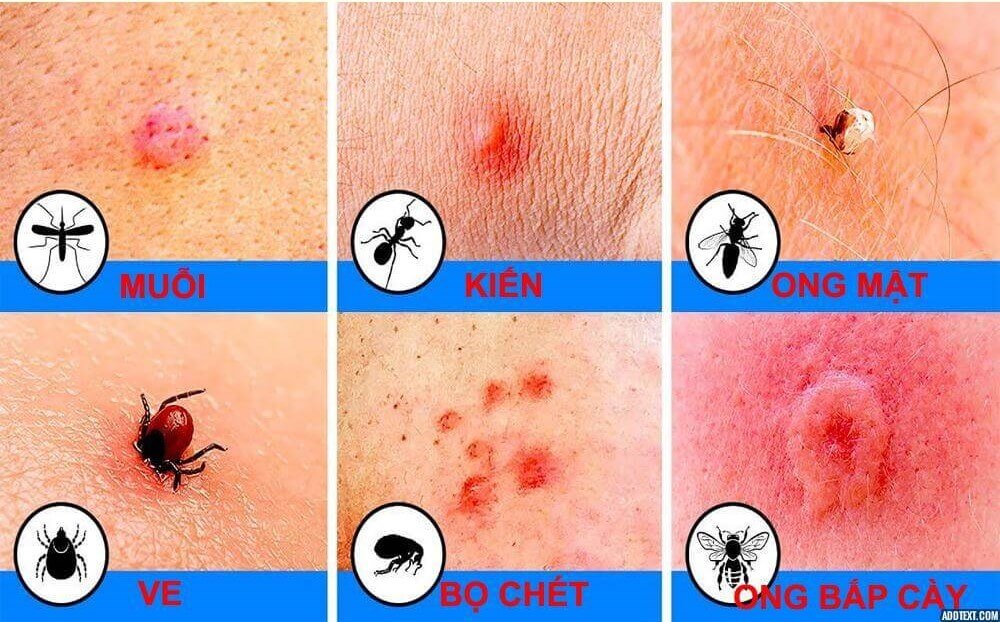 dấu hiệu nhận biết côn trùng đốt