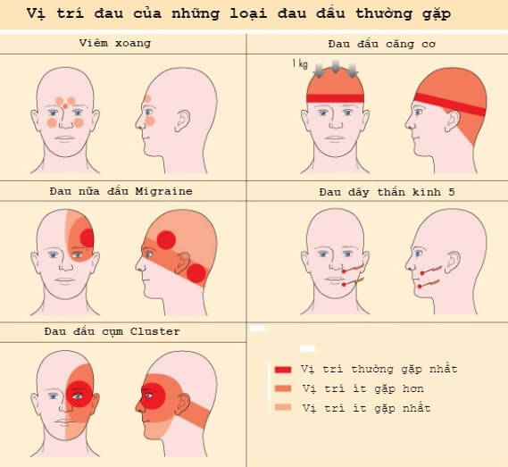 chữa trị đau đầu