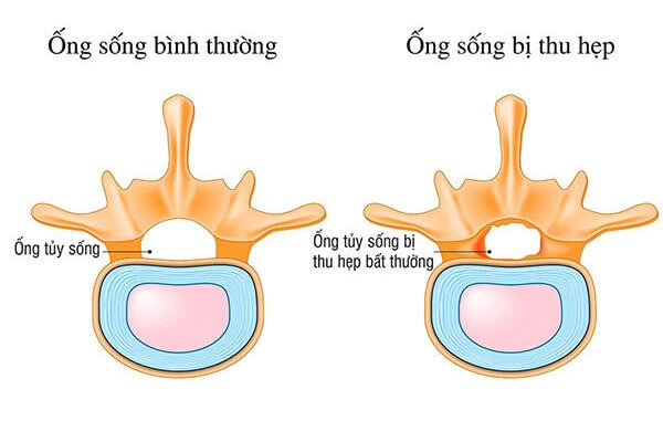hẹp ống sống
