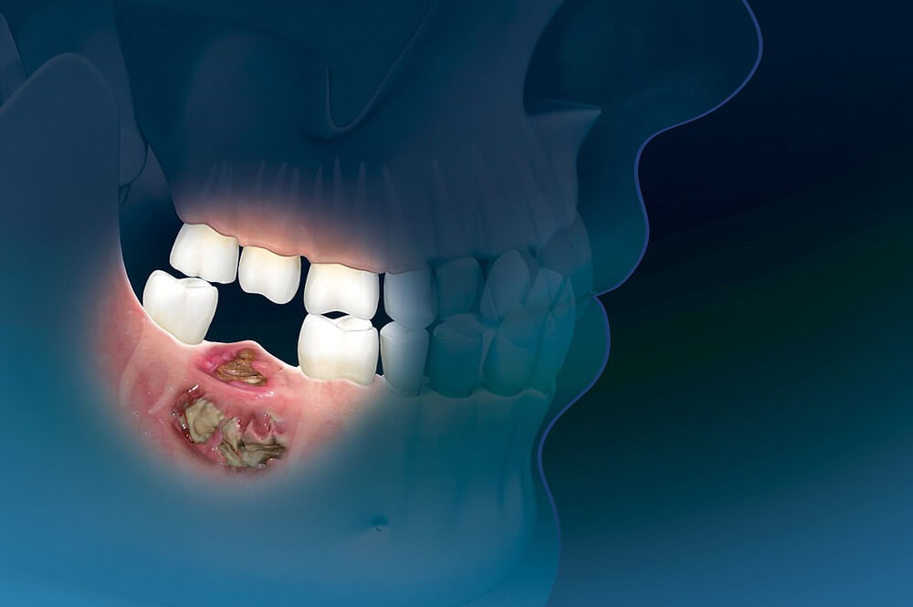 chữa trị hoại tử xương hàm