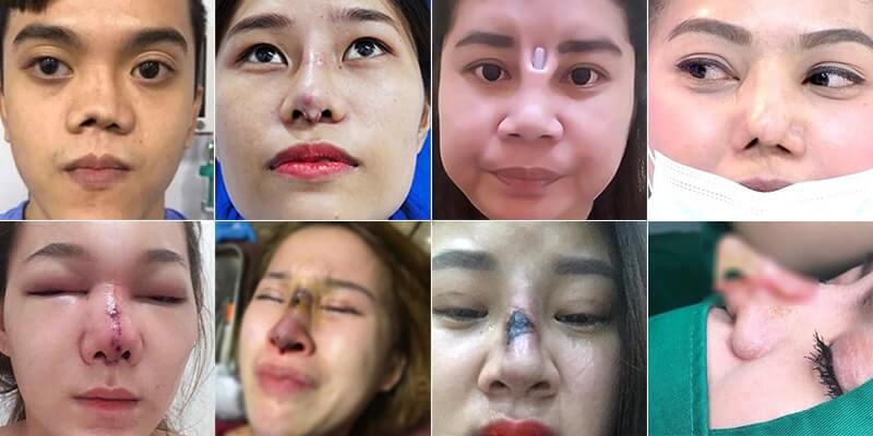 Một số trường hợp nhiễm trùng mũi