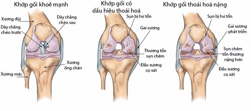 các giai đoạn thoái hóa khớp gối