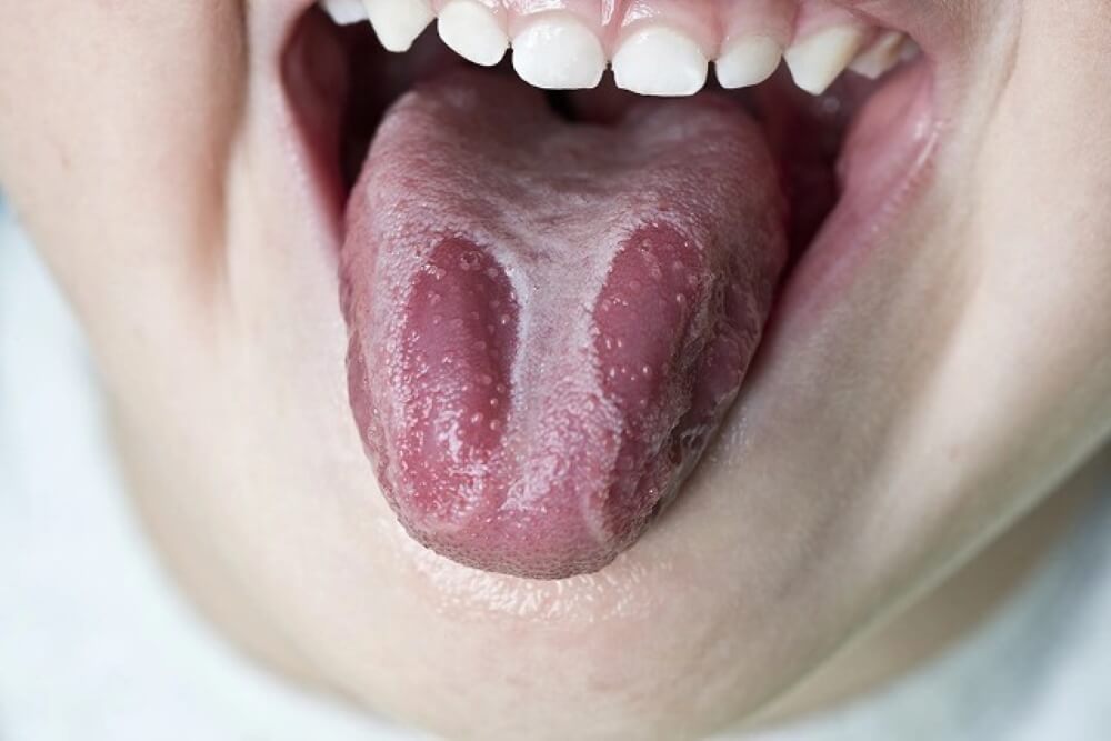 Lưỡi bản đồ là gì? Dấu hiệu nhận biết và phương pháp chữa trị