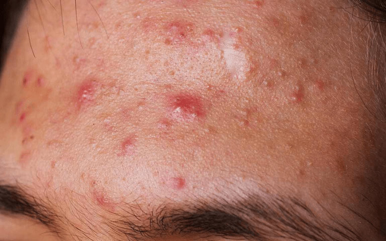 Mụn trứng cá viêm: Nguyên nhân, chẩn đoán và phương pháp điều trị