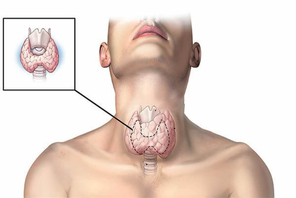 U tuyến giáp là gì? Nguyên nhân, triệu chứng và cách chữa trị
