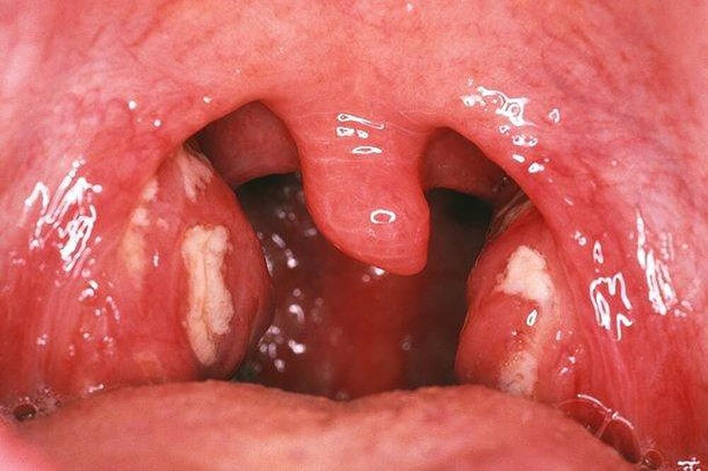 Viêm amidan nguy hiểm không? Nguyên nhân, triệu chứng và cách chữa trị