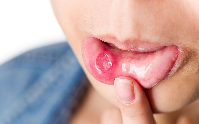 Viêm loét miệng ở trẻ: Nguyên nhân, triệu chứng và cách chữa trị