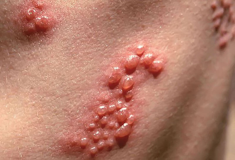 chữa trị herpes