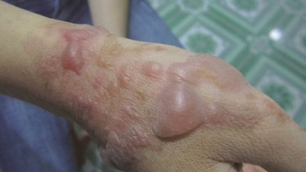 Phỏng da là một tình trạng khi da bị tổn thương do tiếp xúc với nhiệt độ cao