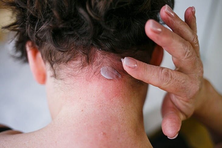 chữa trị vảy nến da đầu
