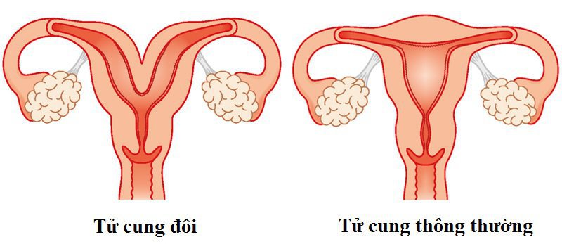 tử cung đôi