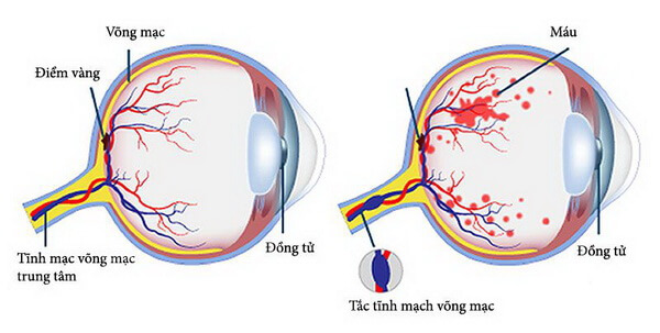 viêm tắc tĩnh mạch võng mạc