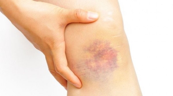dấu hiệu bệnh máu trắng