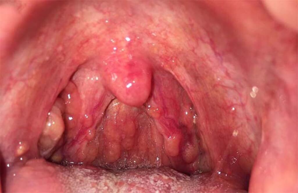 Chữa trị cổ họng nổi hạt