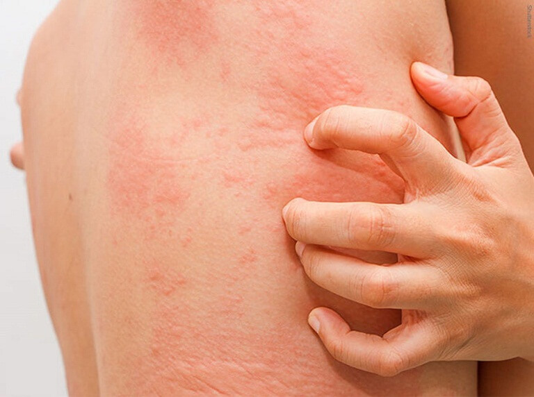 Nổi mề đay là gì? Có nguy hiểm không? Nguyên nhân, dấu hiệu và cách chữa trị