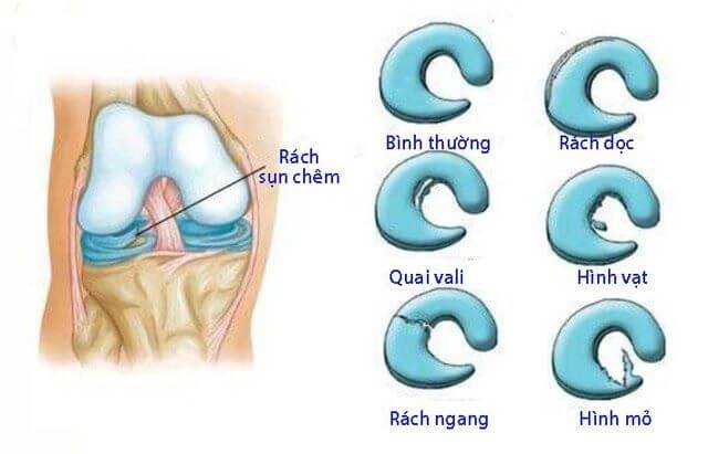 Rách sụn chêm khớp gối