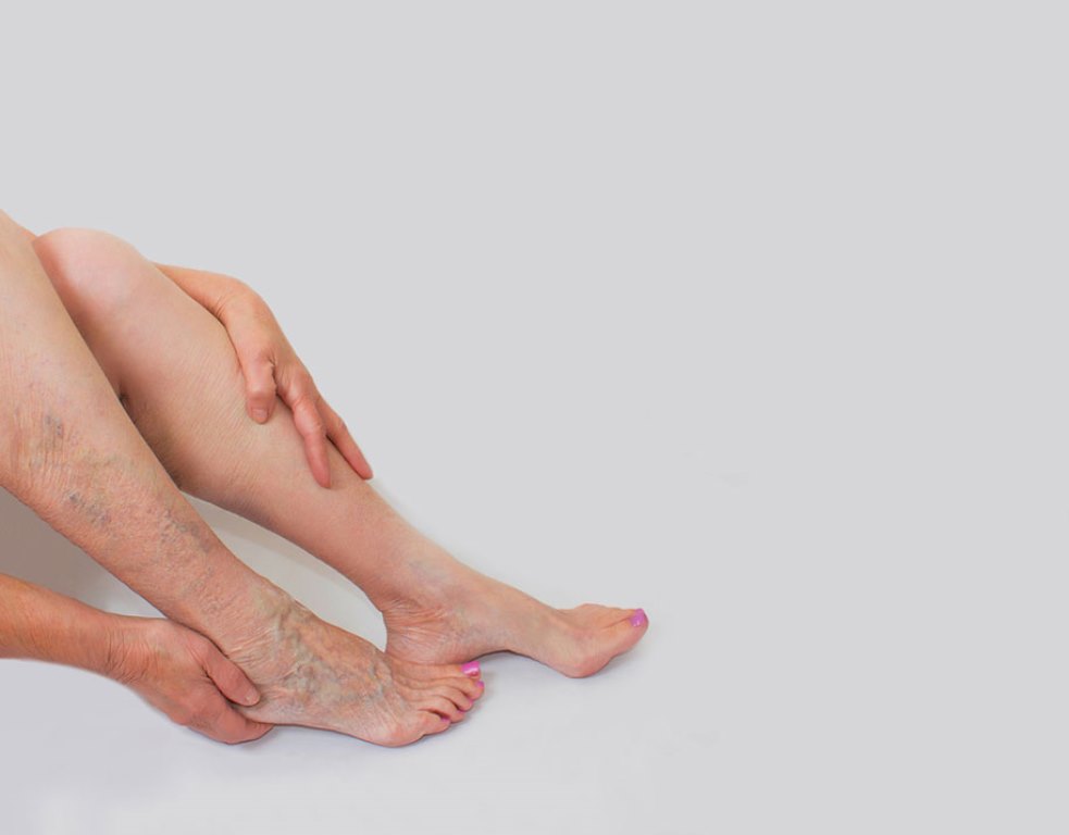 Chữa trị suy giãn tĩnh mạch