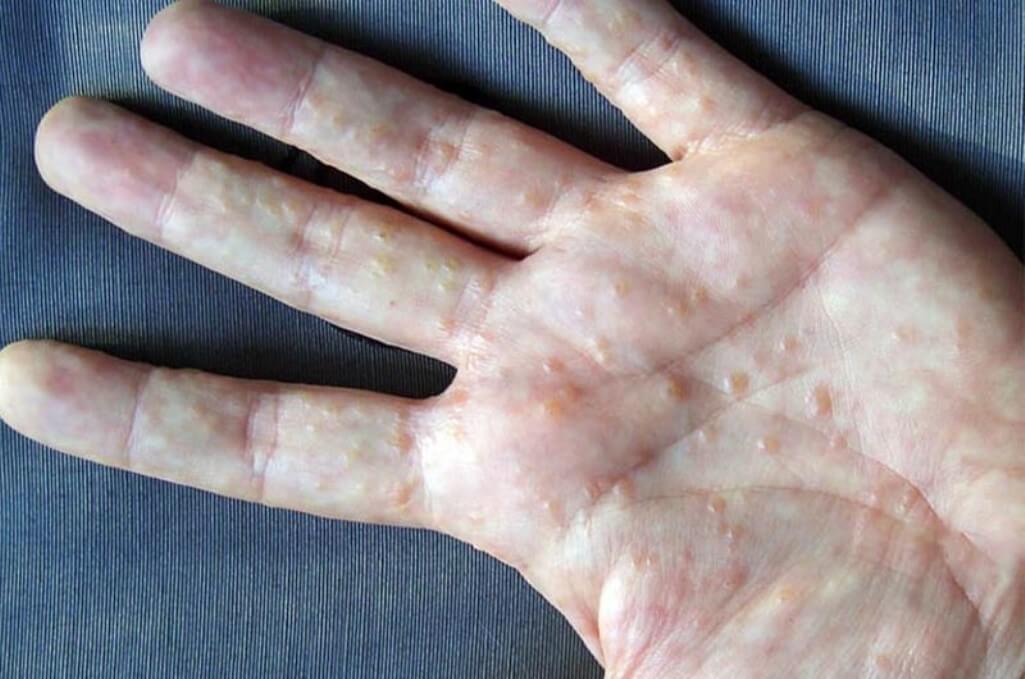 Chữa trị tổ đỉa