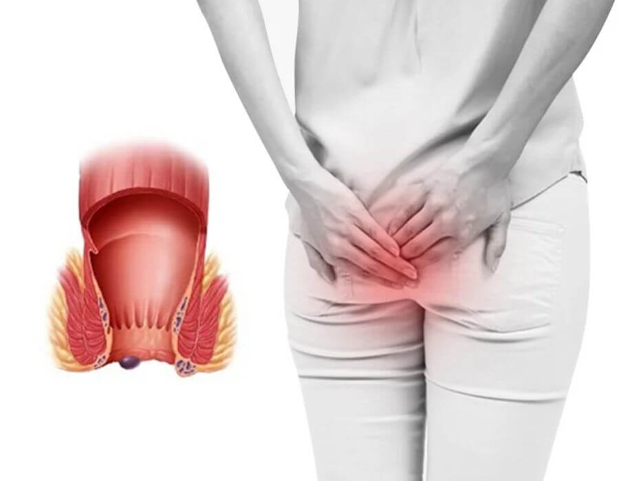 Dấu hiệu nhận biết Trĩ ngoại? Nguyên nhân và Phương pháp chữa trị hiệu quả