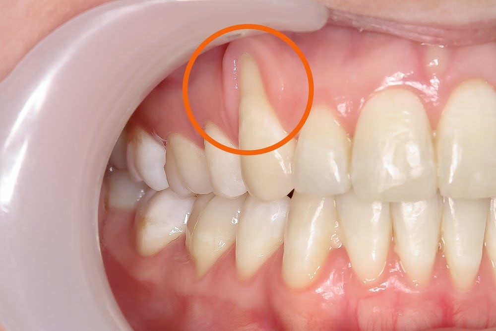 Chữa trị tụt lợi