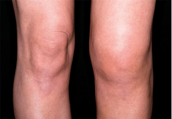 Chữa trị viêm khớp nhiễm khuẩn