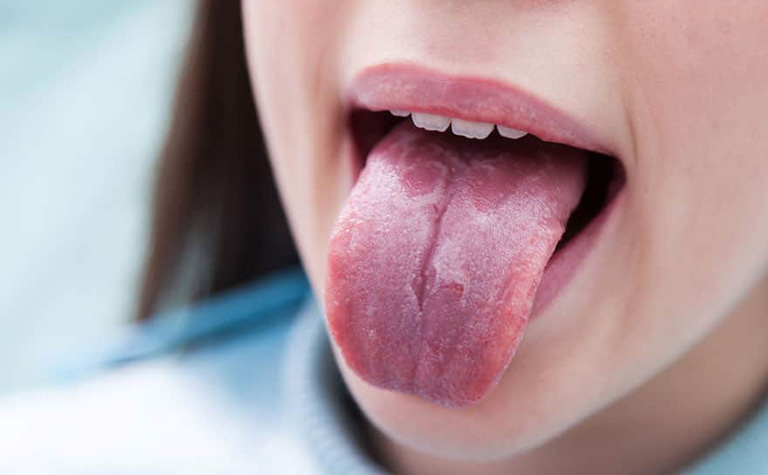 Chữa trị viêm lưỡi