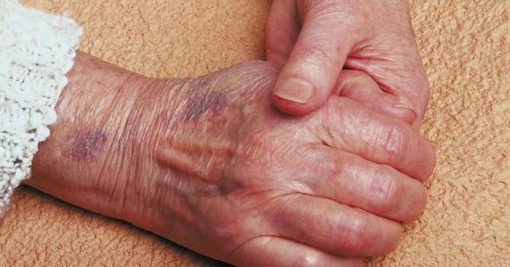 Xuất huyết dưới da có nguy hiểm không? Chẩn đoán bệnh lý và cách chữa trị