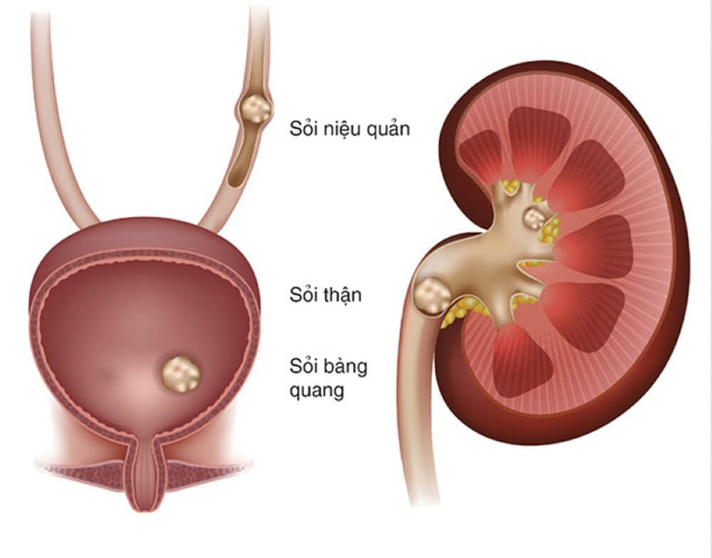 Sỏi niệu quản: Nguyên nhân, triệu chứng và cách chữa trị tận gốc