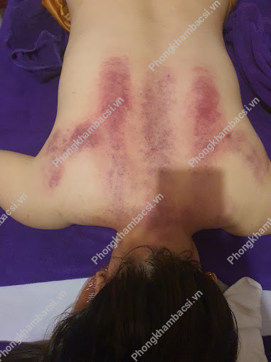 Massage Châm Cứu Ấn Huyệt Trị Liệu - Đà Lạt